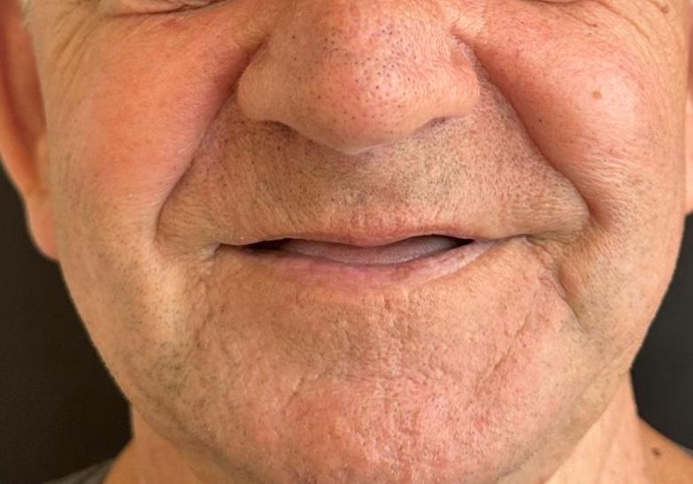 Antes - Reabilitação Completa