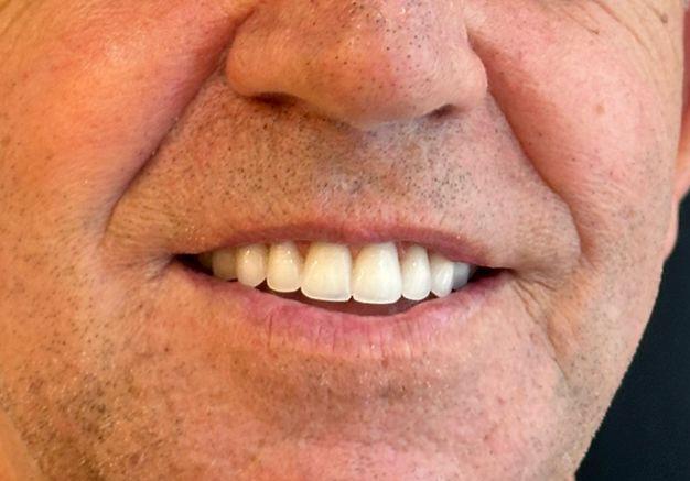 Depois - Reabilitação Completa